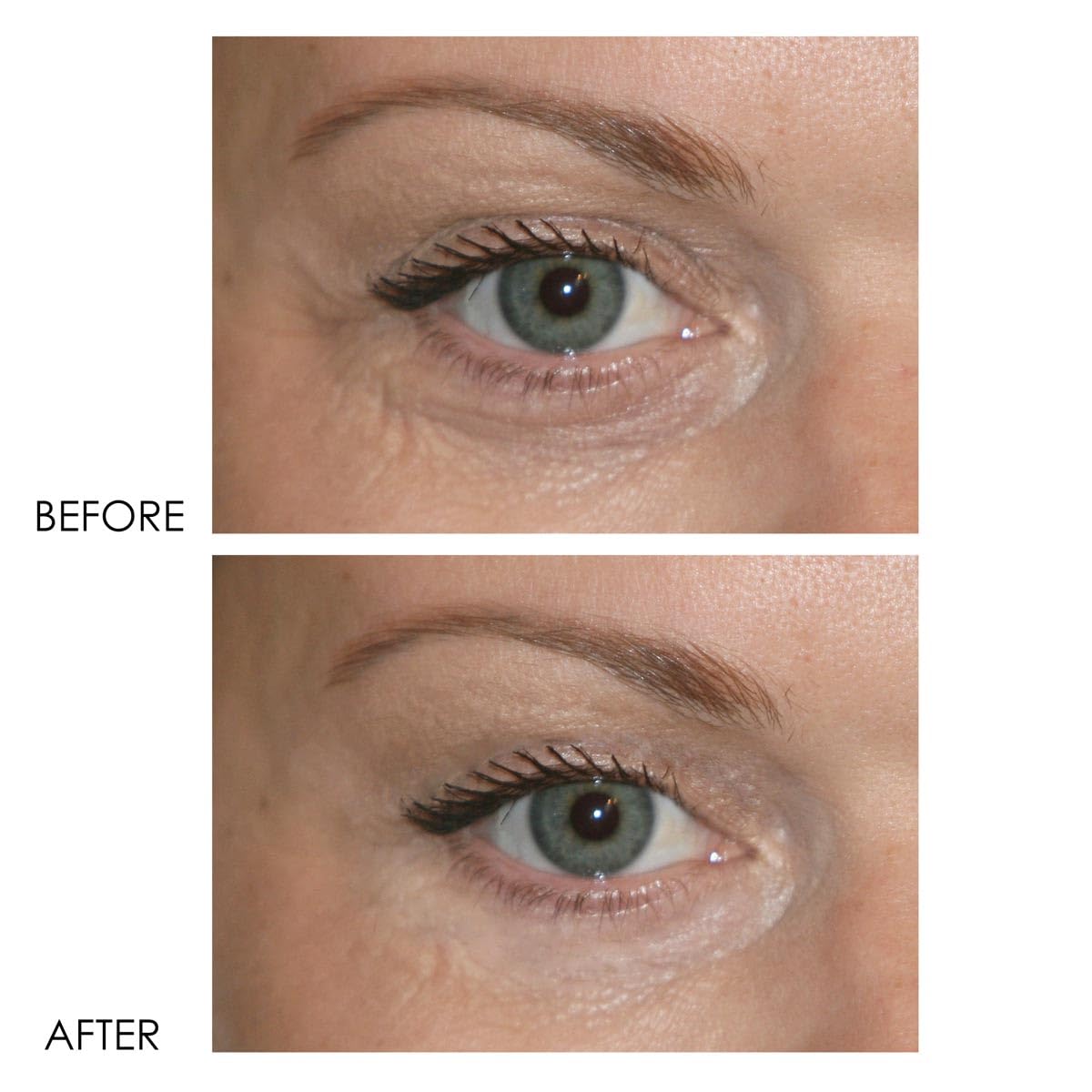 Dermelect Revitalite Eyelid & Dark Circle Corrector- Professional Strength, Anti-Aging Eye Cream with Peptides, Brightening & Tightening Ingredients- Dark Circles, Puffiness, Droopy Eyelids & Wrinkles